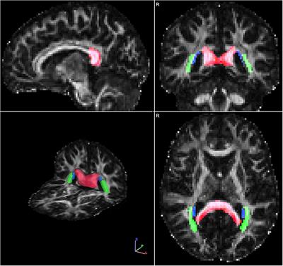 Posterior white matter integrity and self-reported posterior cortical symptoms using the Colorado Posterior Cortical Questionnaire